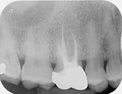 Fractured file removal and re-rct - 12 month review